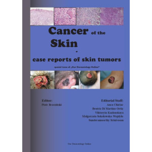Cancer of the Skin - case reports of skin tumors [E-Book] [pdf]