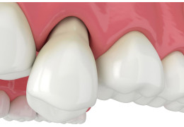 Jak uporać się z problemem odsłoniętych szyjek zębowych?